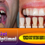 Veneer Gigi