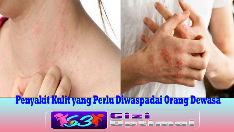 Penyakit Kulit yang Perlu Diwaspadai Orang Dewasa